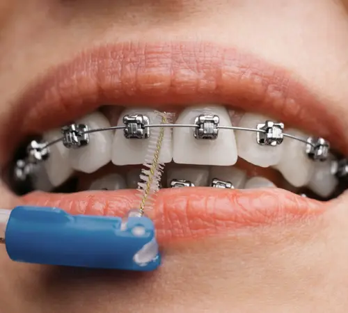 Ortodontik Probleminiz Olduğunu Nasıl Anlarsınız? Belirtiler ve Erken Tanı