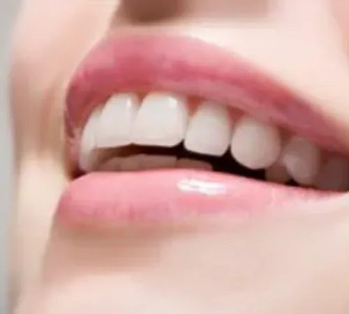 Diş Eti Çekilmesi Nedir? Belirtileri, Nedenleri ve Evde Alınabilecek Önlemler