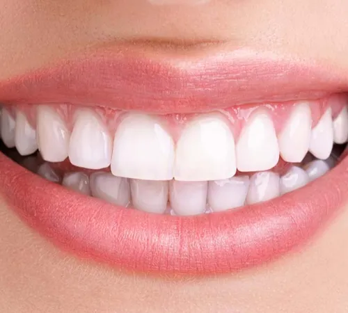 Diş Taşı Nedir? Neden Oluşur ve Nasıl Temizlenir?